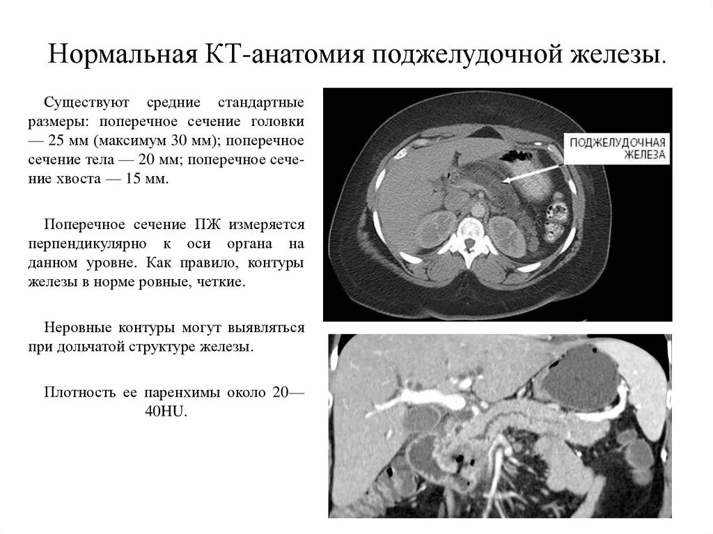 Поджелудочная железа узи норма у мужчин. Кальцификация поджелудочной железы кт. Проток поджелудочной железы норма на кт. Кт поджелудочной железы норма. Плотность паренхимы поджелудочной железы на кт.