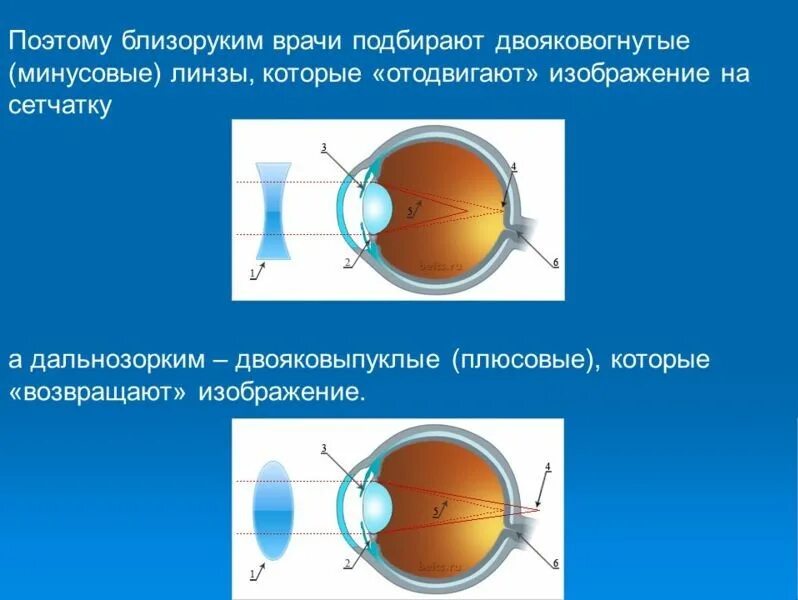 Дальнозоркость линзы двояковыпуклые. Линзы двояковыпуклые близорукость и дальнозоркость. Двояковогнутая линза. Двояковогнутая линза для близорукости. Двояковыпуклая линза для дальнозоркости.