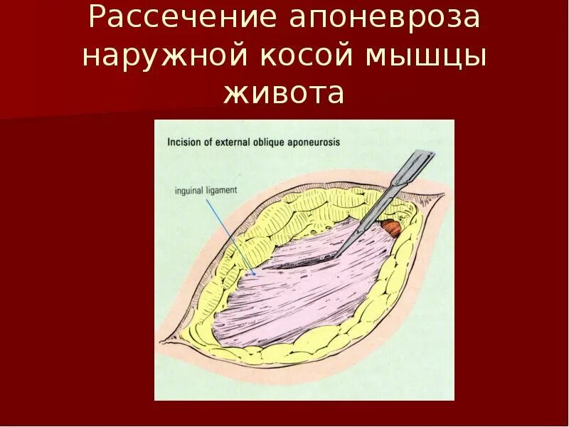 Рассечение термин. Апоневроз брюшной полости. рассечение апоневроза наружной косой мышцы. апоневроз наружной косой мышцы живота. рассечение апоневроза косой мышцы живота.