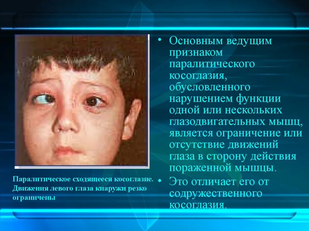 Косоглазие симптомы. Паралитическое сходящееся косоглазие. симптомы косоглазия. глазодвигательные нарушения. содружественное или паралитическое косоглазие.