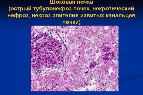 Почечная недостаточность патанатомия