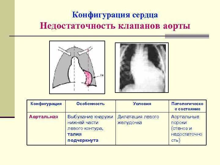 Конфигурации сердца. Аортальная и митральная конфигурация сердца на рентгенограмме. митральная конфигурация сердца рентген. аортальная конфигурация сердца схема. аортальная недостаточность конфигурация сердца.