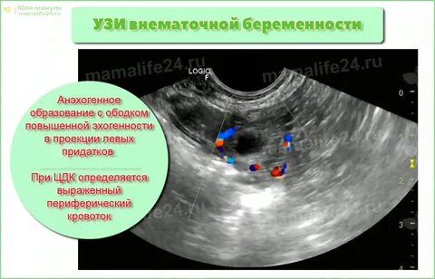 Маточная беременность как отличить