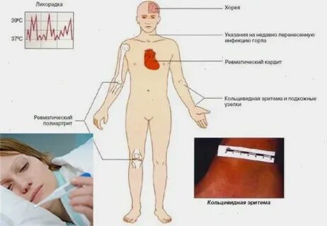 Лихорадки острые и хронические