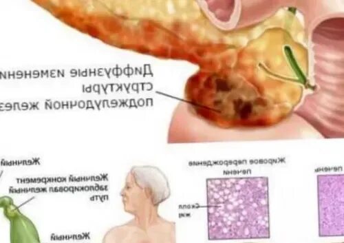 Диффузные изменения печени. Изменение поджелудочной железы у ребенка. Диффузные изменения поджелудочной. Изменения паренхимы печени и поджелудочной железы что это. Диффузное изменение поджелудочной неспецифического характера