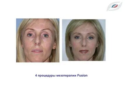 Фьюжн мезотерапия