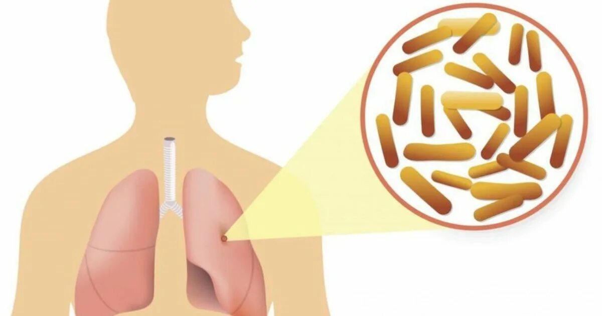 Treatment tb. Микобактериум авиум. Факторы риска туберкулеза легких. Иконка заболевание легких. Tuberculosis disease.