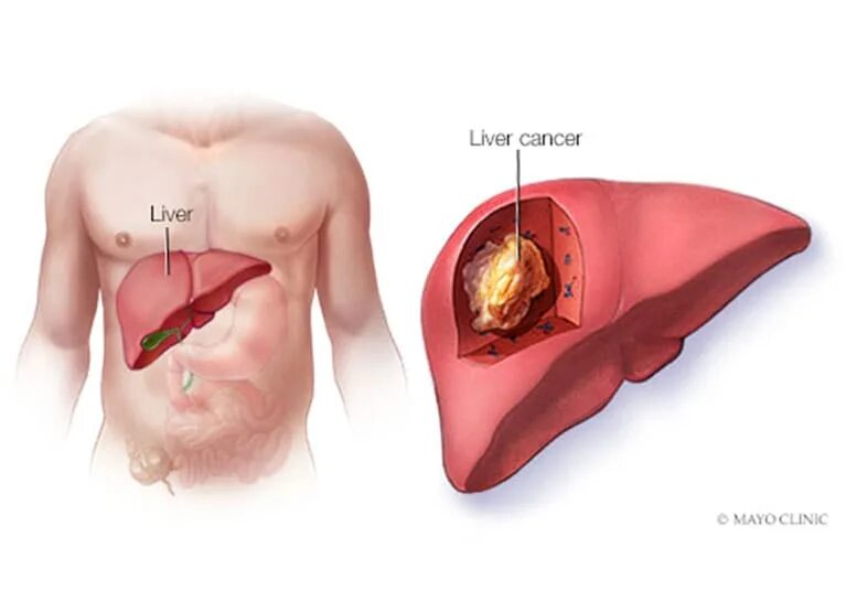 How High Blood Pressure and High Cholesterol Affect Your Liver