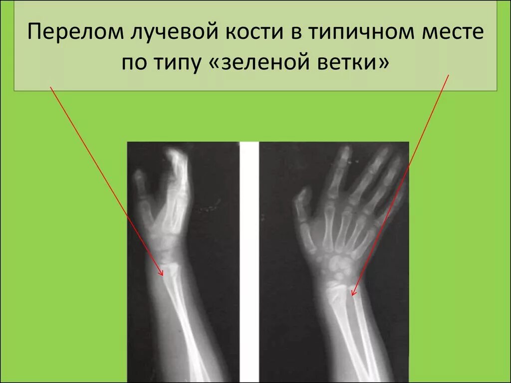 Повреждение зоны роста. Перелом лучевой кости со смещением рентген. Поднадкостничный перелом лучевой кости у детей рентген. Надкостничный перелом по типу зеленой веточки. Закрытый перелом поднадкостничный перелом лучевой.