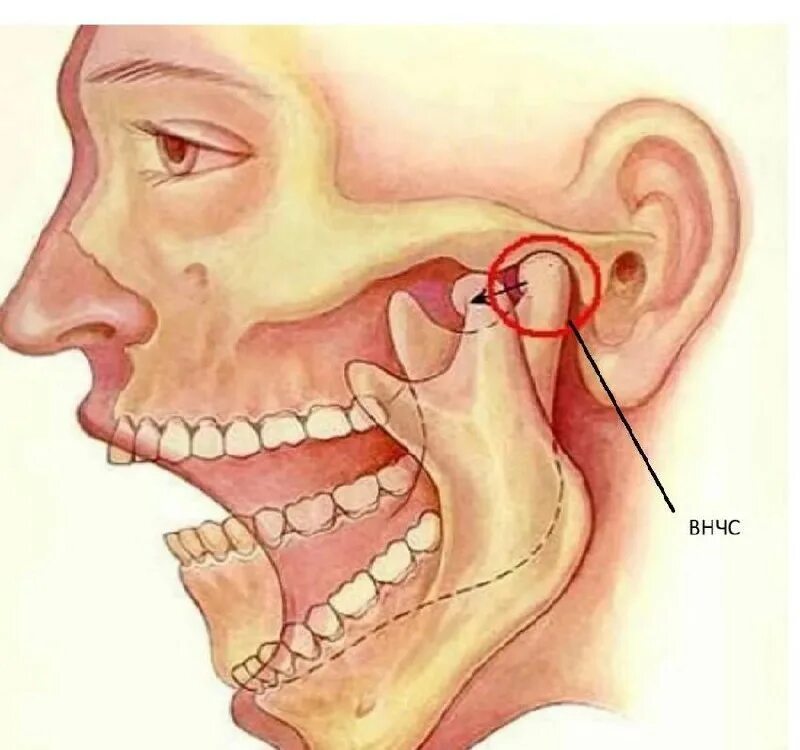 Внчс уха. Двусторонний вывих ВНЧС. Аллотрансплантат ВНЧС.