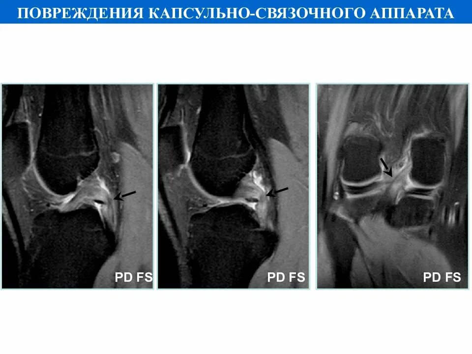 Разрыв капсульно связочного аппарата. Повреждениям капсульно-связочного аппарата суставов. Повреждение капсульномвязочногт аппарата. Частичное повреждение капсульно-связочного аппарата.
