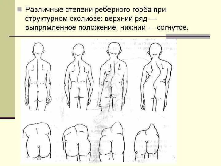 Горбы несущие