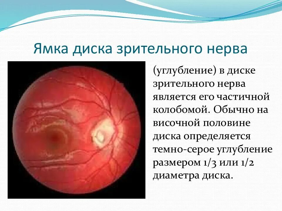 Ямка диска зрительного нерва. Аномалии диска зрительного нерва. Углубление диска зрительного нерва. Ямочки зрительного нерва.