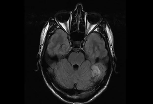 Лейкоэнцефалит. Лейкоэнцефалит ван богарта. лейкоэнцефалит шильдера. лейкоэнцефалит шильдера мрт. лейкоэнцефалит головного мозга на мрт.