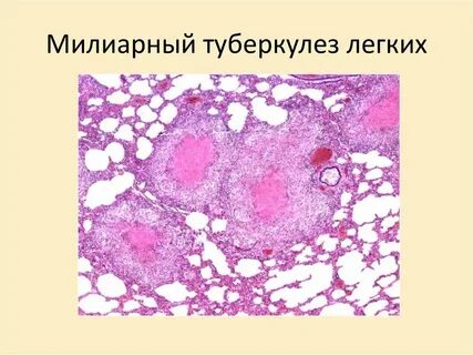 Милиарный туберкулез легких описание