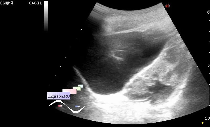 Апоплексия яичника УЗИ картина. Апоплексия правого яичника УЗИ. Апоплексия левого яичника. Анемическая форма.. УЗИ при апоплексии яичника.