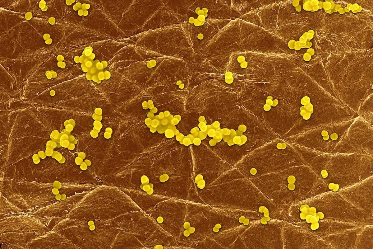 Золотистая инфекция. S. aureus золотистый стафилококк. Стафилококк ауреус заболевания. Стафилококкус ауреус. Стафилококк золотистый Staphylococcus aureus.