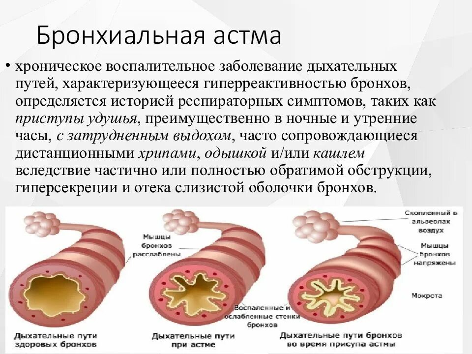 Бронхит история. Патоморфология бронхиальной астмы. Хроническая бронхиальная астма. Атопическая бронхиальная астма. Бронхиальная астма презентация.