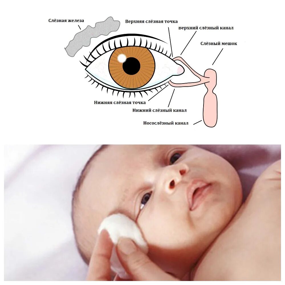 Лечить слезный канал. Мембрана носослезного канала у новорожденных. Носослезный канал воспаление у новорожденных. Слезный мешок у новорожденных. Схема носослезного канала.
