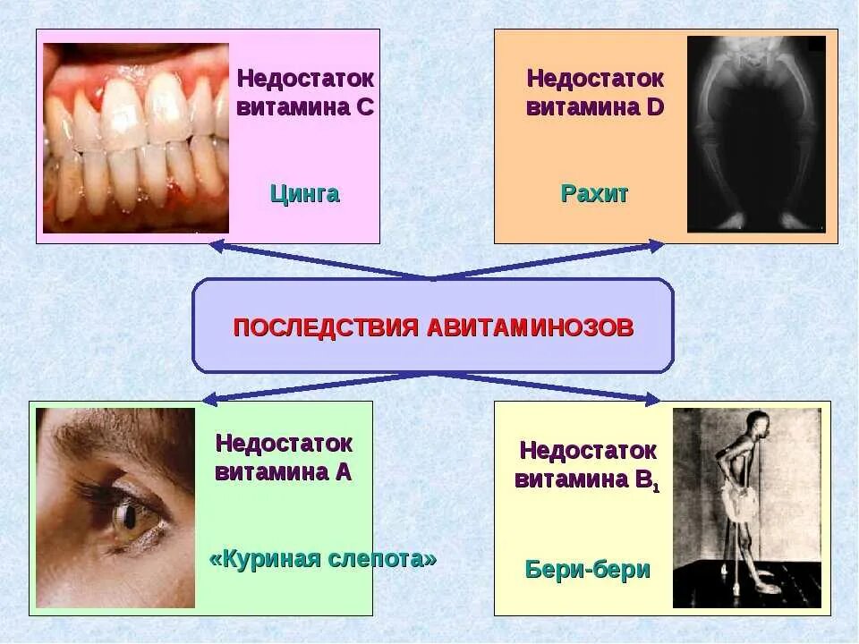 Недостаток витамина а вызывает заболевание. Цинга (дефицит витамина с). Последствия дефицита витаминов. Осложнения авитаминоза.