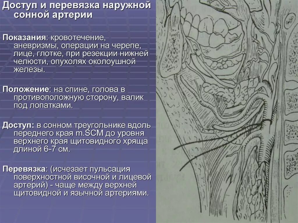 Операция на артерии шеи. Коллатеральное кровообращение после перевязки общей сонной артерии. Перевязка лицевой язычной наружной сонной артерии. Перевязка наружной сонной артерии коллатеральное кровообращение. Показания к перевязке наружной сонной артерии.