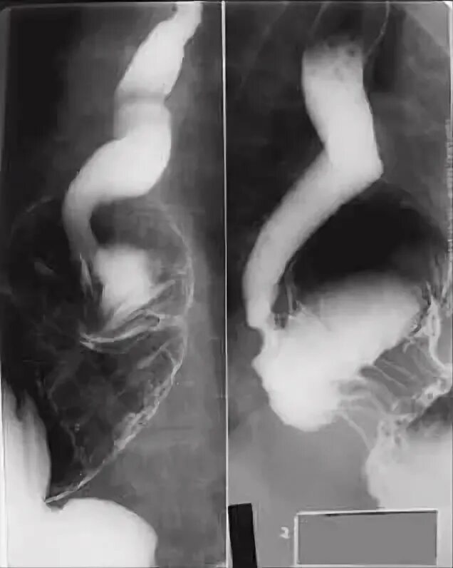 Скопия желудка рентген. Опущение желудка рентген. Язва кардиального отдела желудка рентген. Гастроптоз желудка рентген.