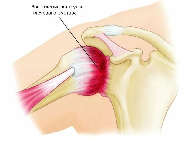 Адгезивный капсулит плечевого сустава. Периартрит плечевого сустава синдром. Плечелопаточный артрит. Лопаточный периартроз плечевого сустава.