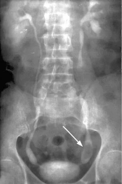 Рентген мочеточника. Экскреторная урография камень мочеточника. Экскреторная урография стриктура мочеточника. Экскреторная урография опухоль почки. Экскреторная урограмма. Опухоль мочеточника.