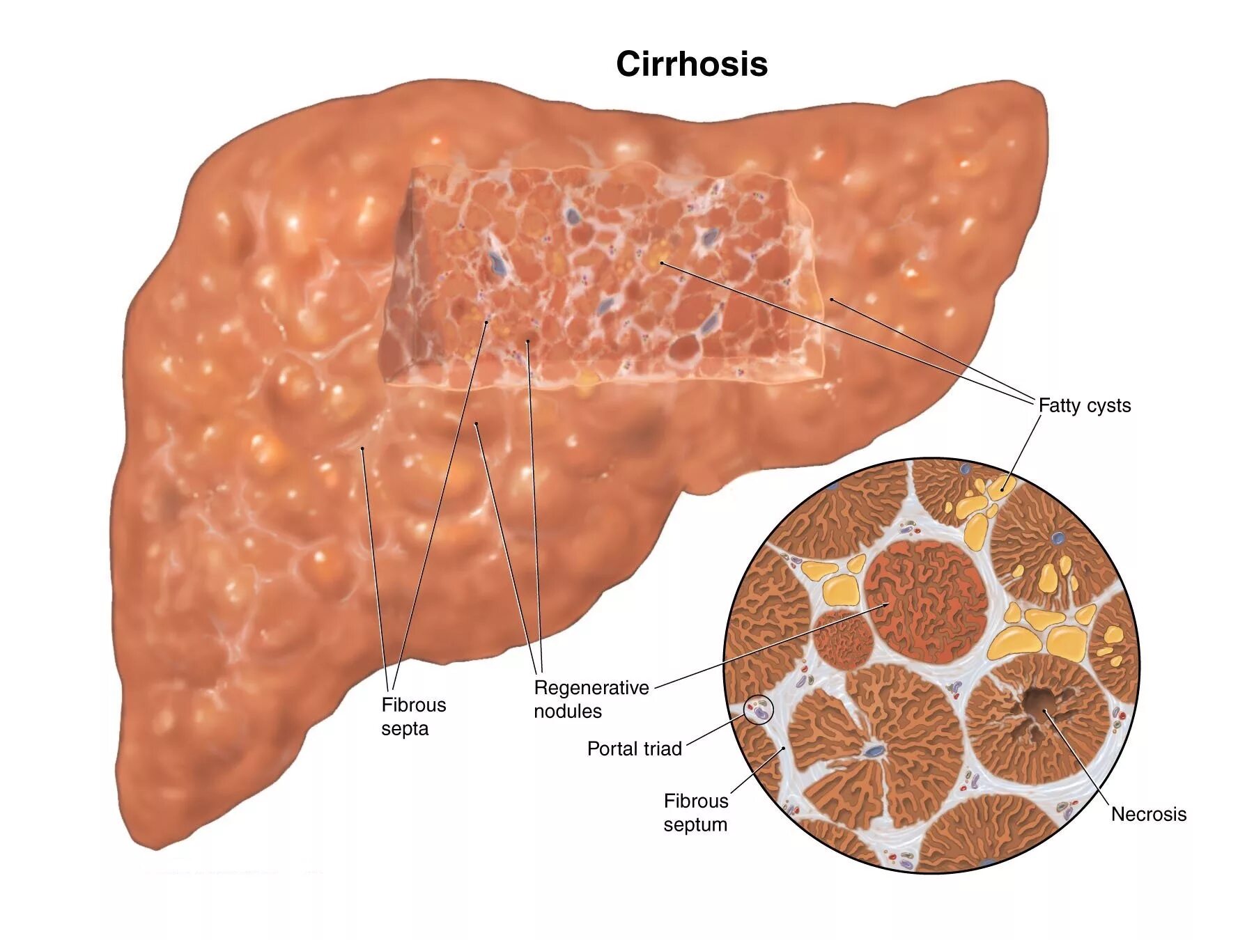 Изменение клеток печени. Фиброзный цирроз печени. Гепатитный цирроз печени.