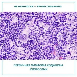 Рак лимфома ходжкина
