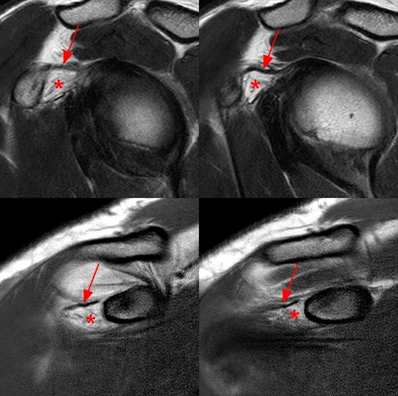 Капсулит симптомы и лечение. Адгезивный капсулит плечевого сустава мрт. Капсулит анкилозирующий. Суставной капсулит плечевого сустава.