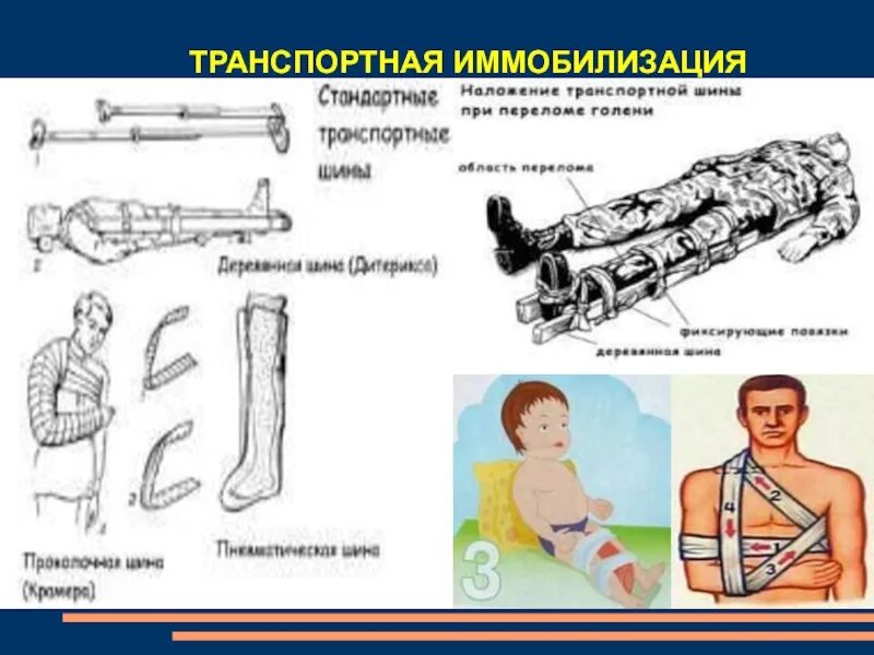 Сроки иммобилизации при переломах у детей таблица При переломе позвоночника необходимо