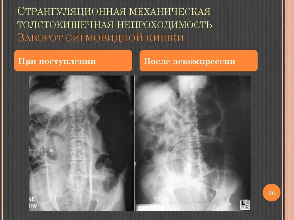 От чего может быть заворот. От чего может быть заворот