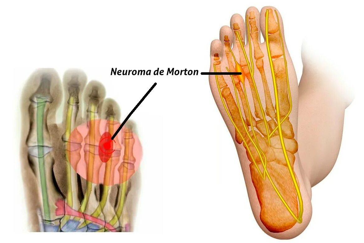 Неврома Мортона операция. Межпальцевая неврома Мортона. Метатарзалгия неврома Мортона. Нейрома