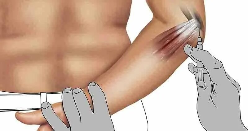 Как выглядит рука после укола File:Intramuscular  Wikipedia