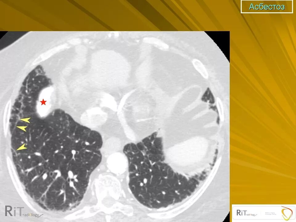 Силикоз патологическая анатомия. Асбест легкого. Асбест легкого. Асбестоз патологическая анатомия. Асбестоз легких рентген.