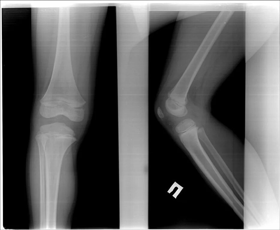 Эпифизеолиз лучевой кости рентген. Эпифизеолиз локтевой кости. Эпифизеолиз головки лучевой кости. Перелом метафиза бедренной кости.
