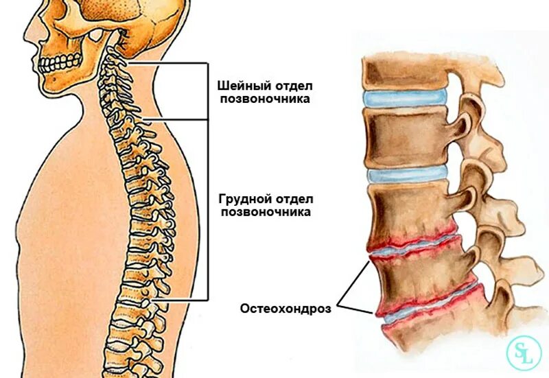 Болит кость позвоночника. Остеохондроз th6-th11. Остеохондроз среднегрудного отдела позвоночника. Строение позвоночника остеохондроз. Остеохондроз шейного позвонка отдела позвоночника.