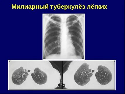 Легкие туберкулезника