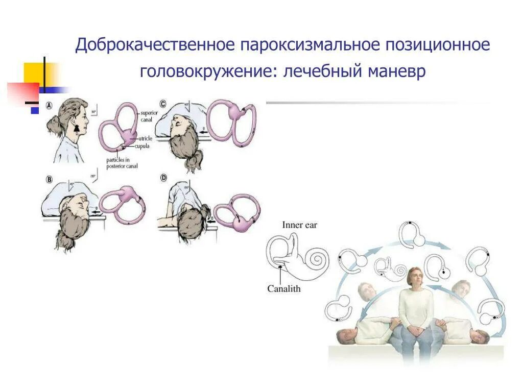 Дппг что это за болезнь. ДППГ доброкачественное пароксизмальное позиционное. Доброкачественное пароксизмальное позиционное головокружение. Доьрокачественное пощиционное головкружение. Доброкачестественное позиционное головокружение.