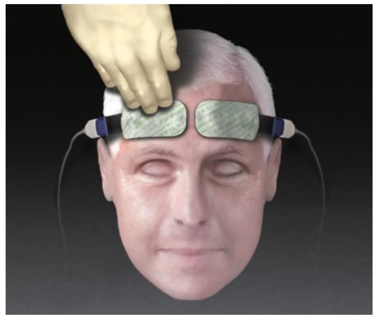 Транскраниальный Пульсоксиметр invos 5100c. Near Infrared Spectroscopy. Торговец Нейро имплантами. Functional Neurosurgery.