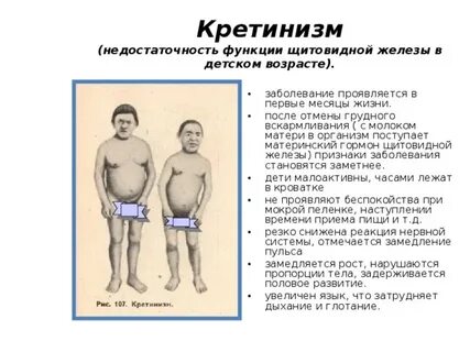 Кретинизм