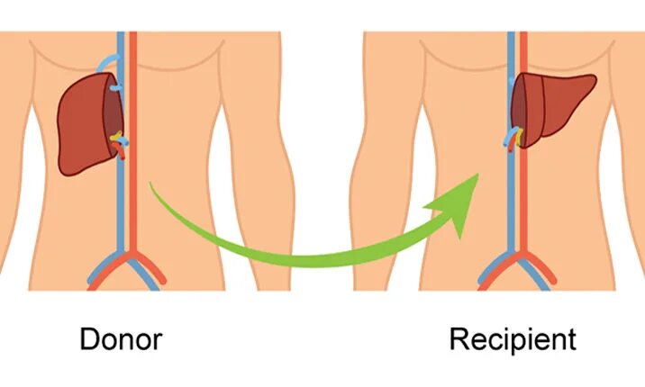 Трансплантация печени. Трансплантация печени и донор. Реабилитация доноров печени. Регенерация донорской печени.
