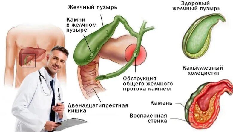 Боль в желчном пузыре чем снять. Проблемы с желчным пузырем. Жёлчный пузырь симптомы. Проблемы с желчным пузырем симптомы.