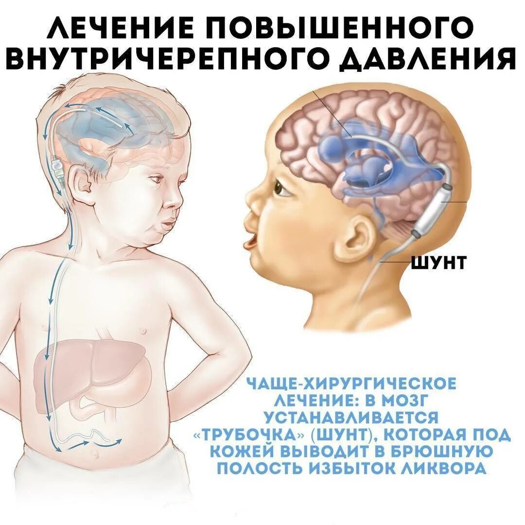 Поражение головного мозга у новорожденных. Давление у грудничков внутричерепное давление. Внутричерепное давление у ребенка 1 год. Черепное давление симптомы у детей. Внутреннее черепное давление.