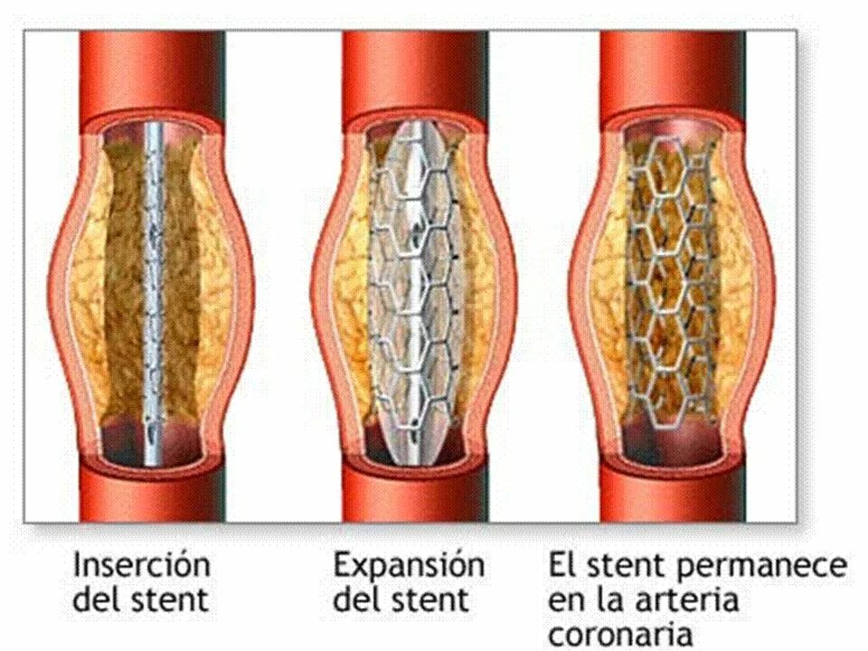 3 стента. Ангиопластика коронарных артерий. Стенты для коронарных сосудов. Ангиопластика со стентированием.