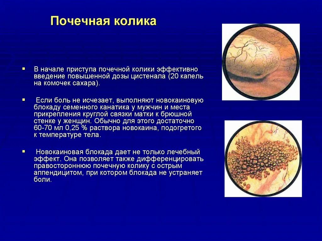 Мочекаменные колики. Почечная колика. Приступ почечной колики.