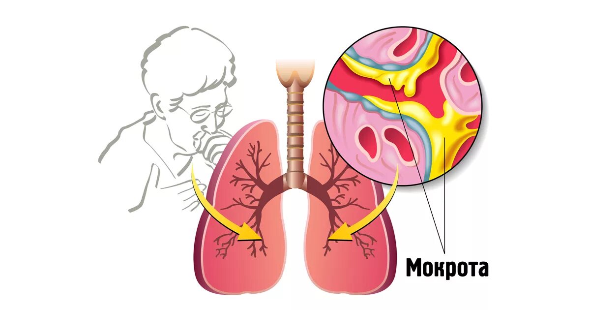 Бронхи и легкие при кашле. Мокрота в дыхательных путях. Осложнения трахеи