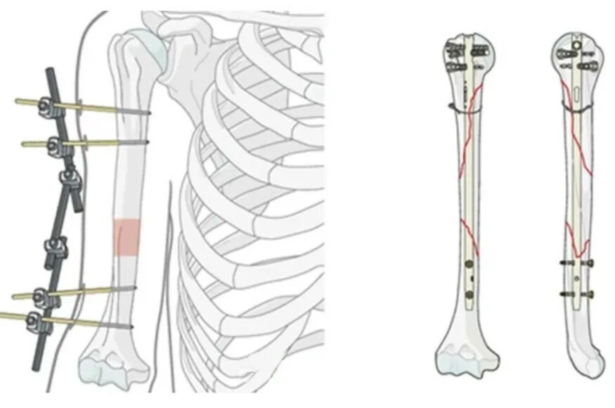 Интрамедуллярный стержневой остеосинтез. Остеосинтез при переломе плечевой кости. Остеосинтез перелома плечевой кости пластиной. Чрескостный компрессионный остеосинтез. Остеосинтез операция пластины