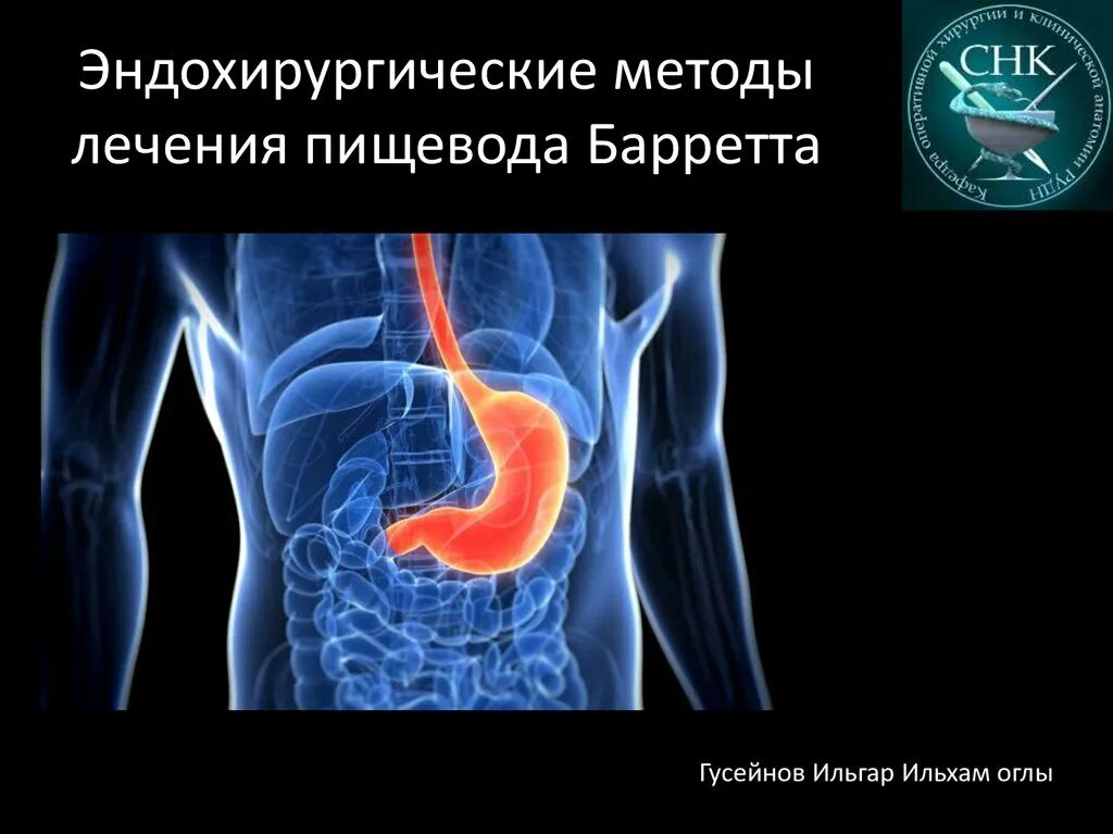 Пищевод баретта. Пражская классификация пищевода Барретта. Пизевод юаррета. Пищевод Барретта гистология. Эндохирургические методы лечения.